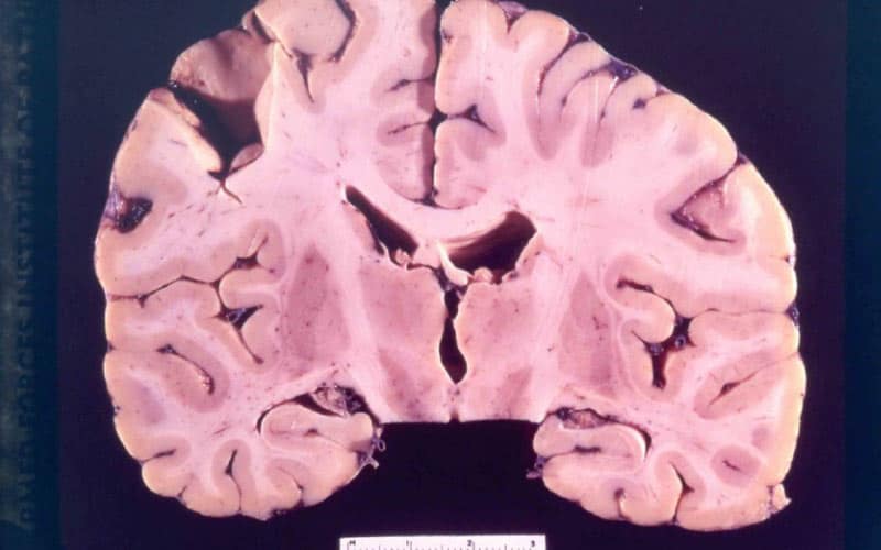 10 Rarest Brain Diseases in the World | Rarest.org