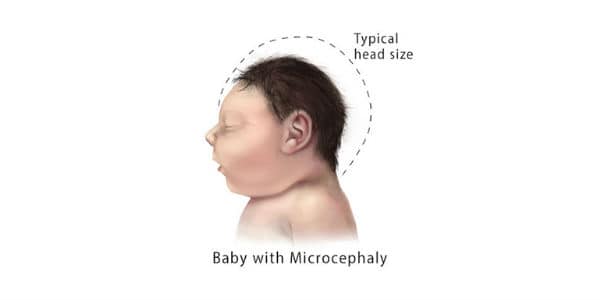 A baby with microcephaly
