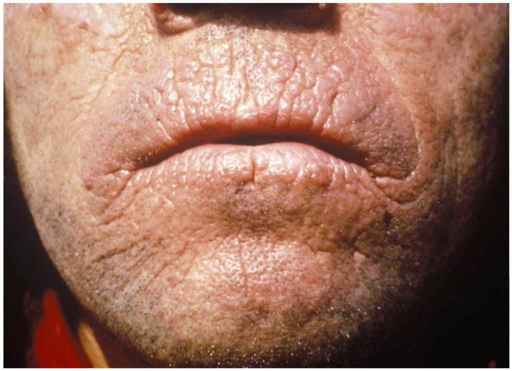 7 Rarest Skin Diseases in the World | Rarest.org