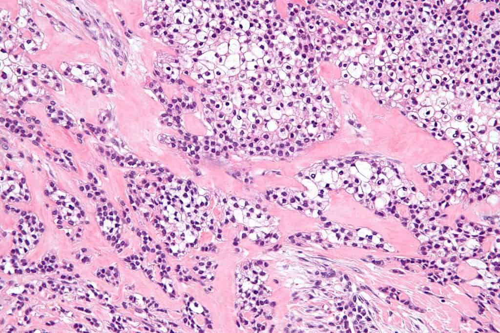 Hyalinizing Clear Cell Carcinoma