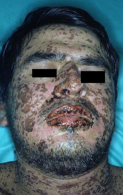 Stevens-Johnson Syndrome and Toxic Epidermal Necrolysis 
