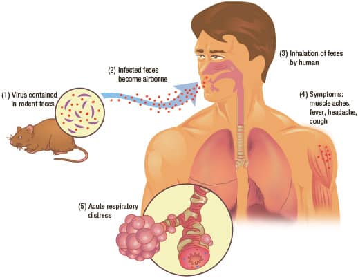 Hantavirus Pulmonary Syndrome