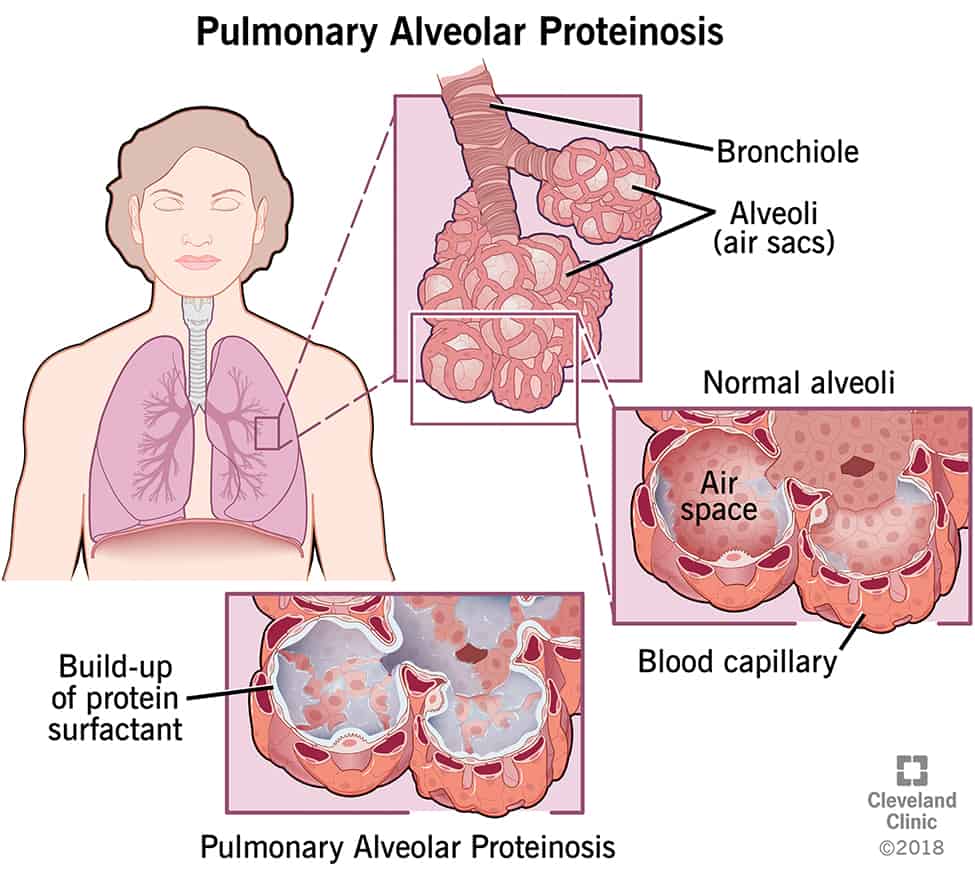 Pulmonary Alveolar Proteinosis
