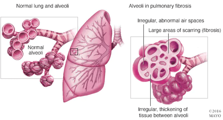 Pulmonary Fibrosis 