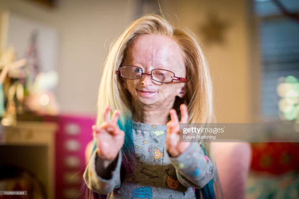 Progeria (HGPS) 