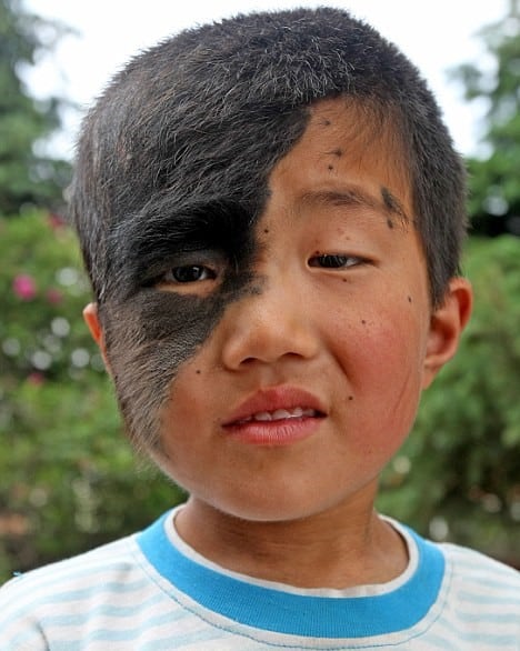 Large Face Birthmark