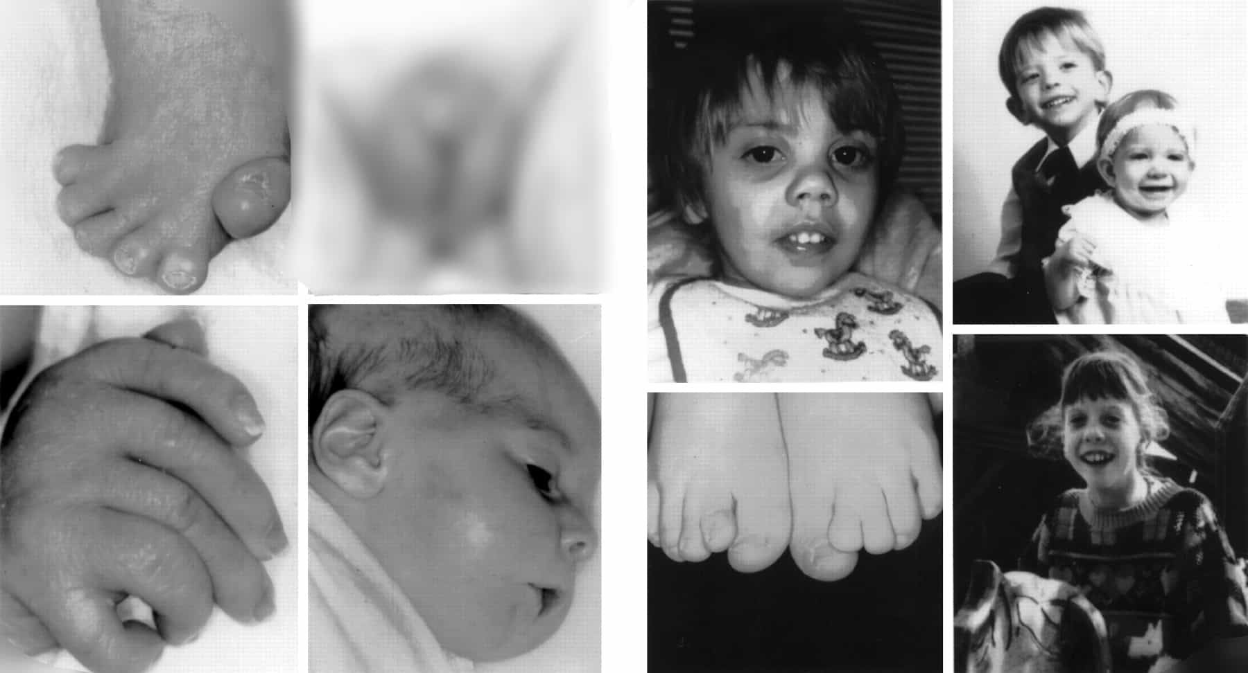 9 Rarest Birth Defects 