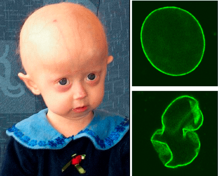 Hutchinson-Gilford Progeria Syndrome (Progeria)