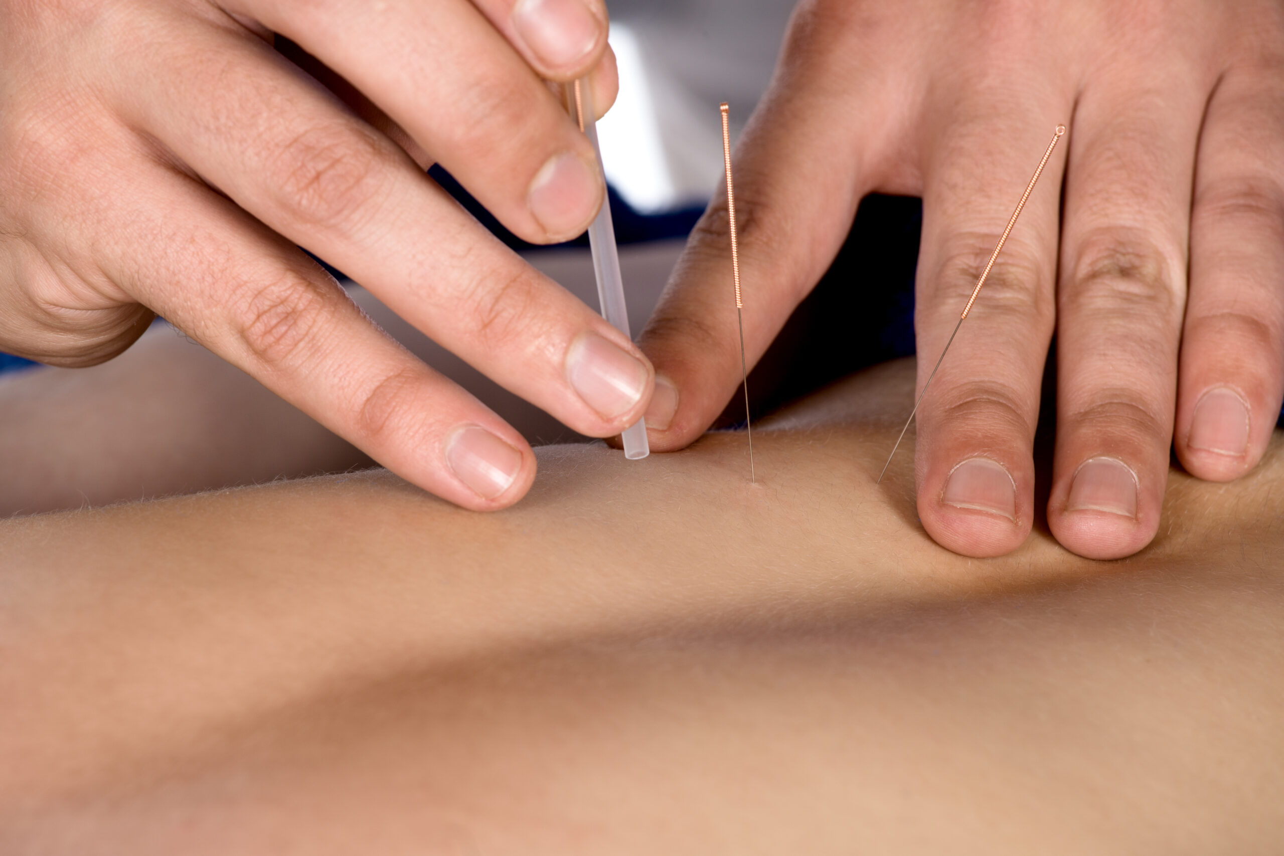 Acupuncture for Muscle Recovery