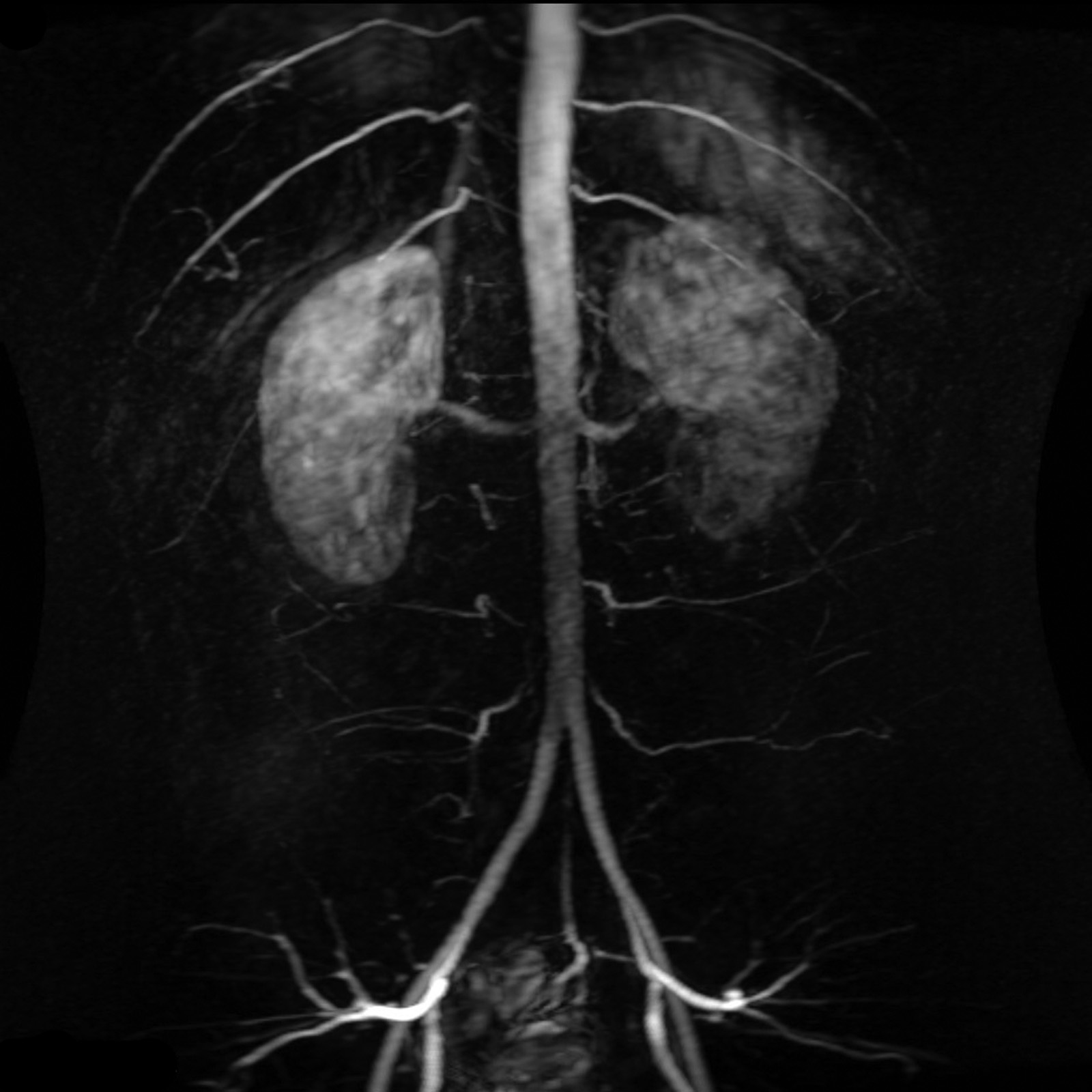 Abdominal Aorta