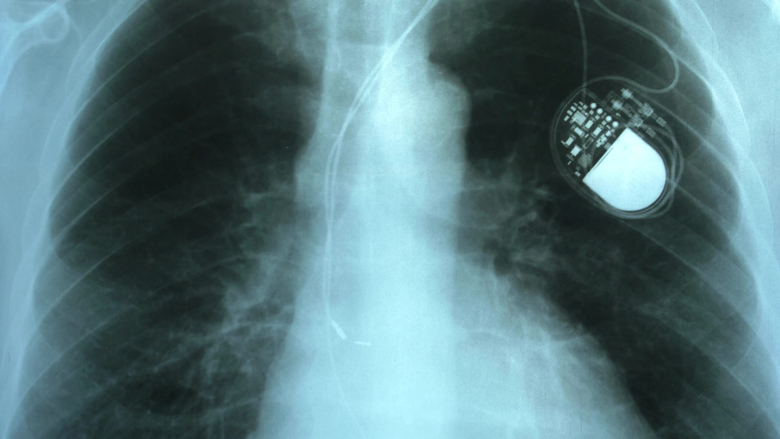 Cardiac Pacemaker (1958)